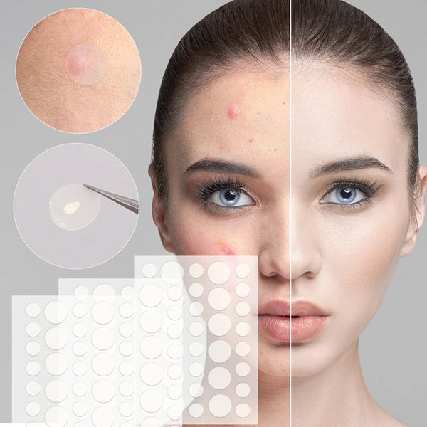 Патчі від прищів та акне 72 шт Acne Patch / Пластир косметичний для лікування акне 234574162 фото